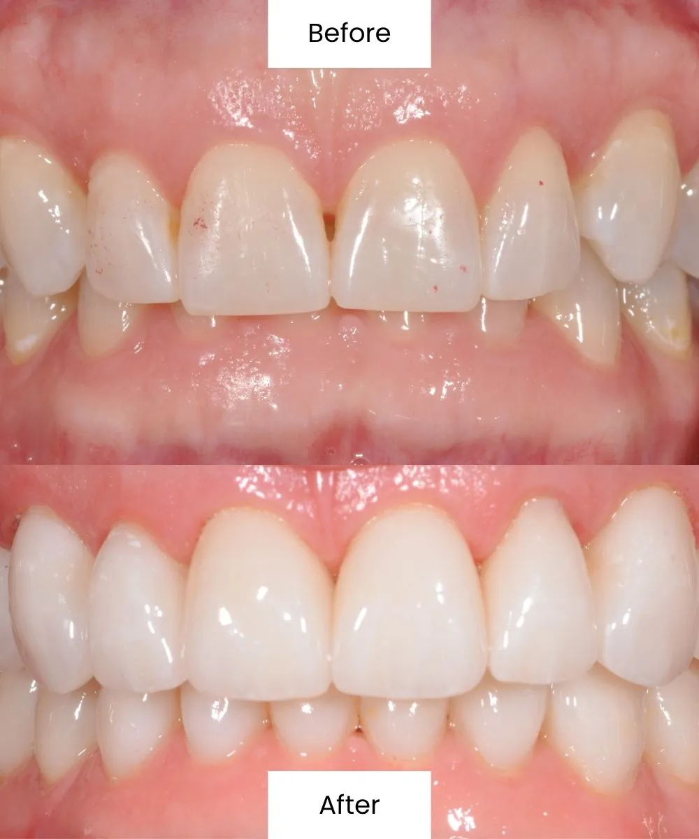 Before and after cosmetic treatment correcting tooth shape and enhancing smile aesthetics