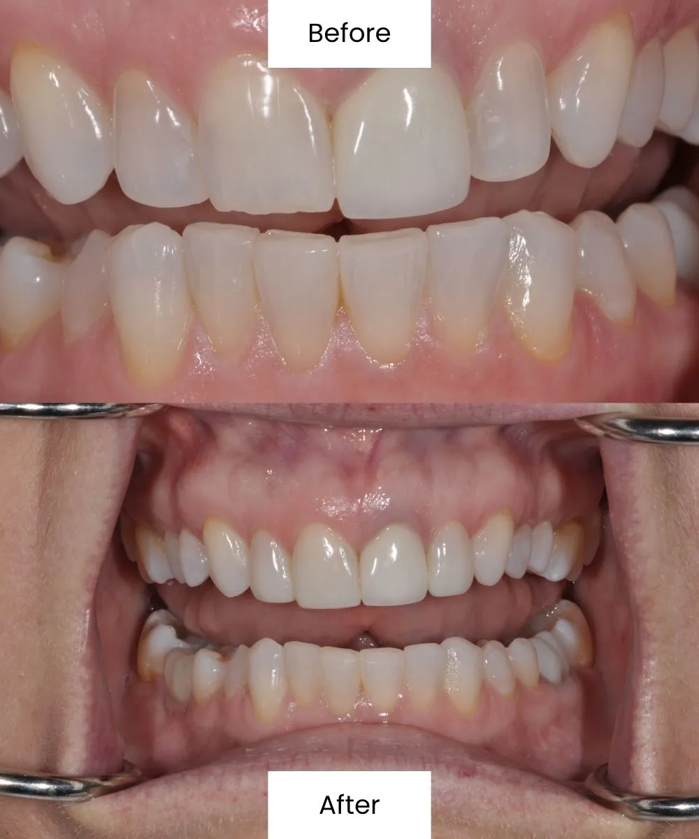 Before and after cosmetic dental treatment enhancing smile aesthetics and tooth appearance