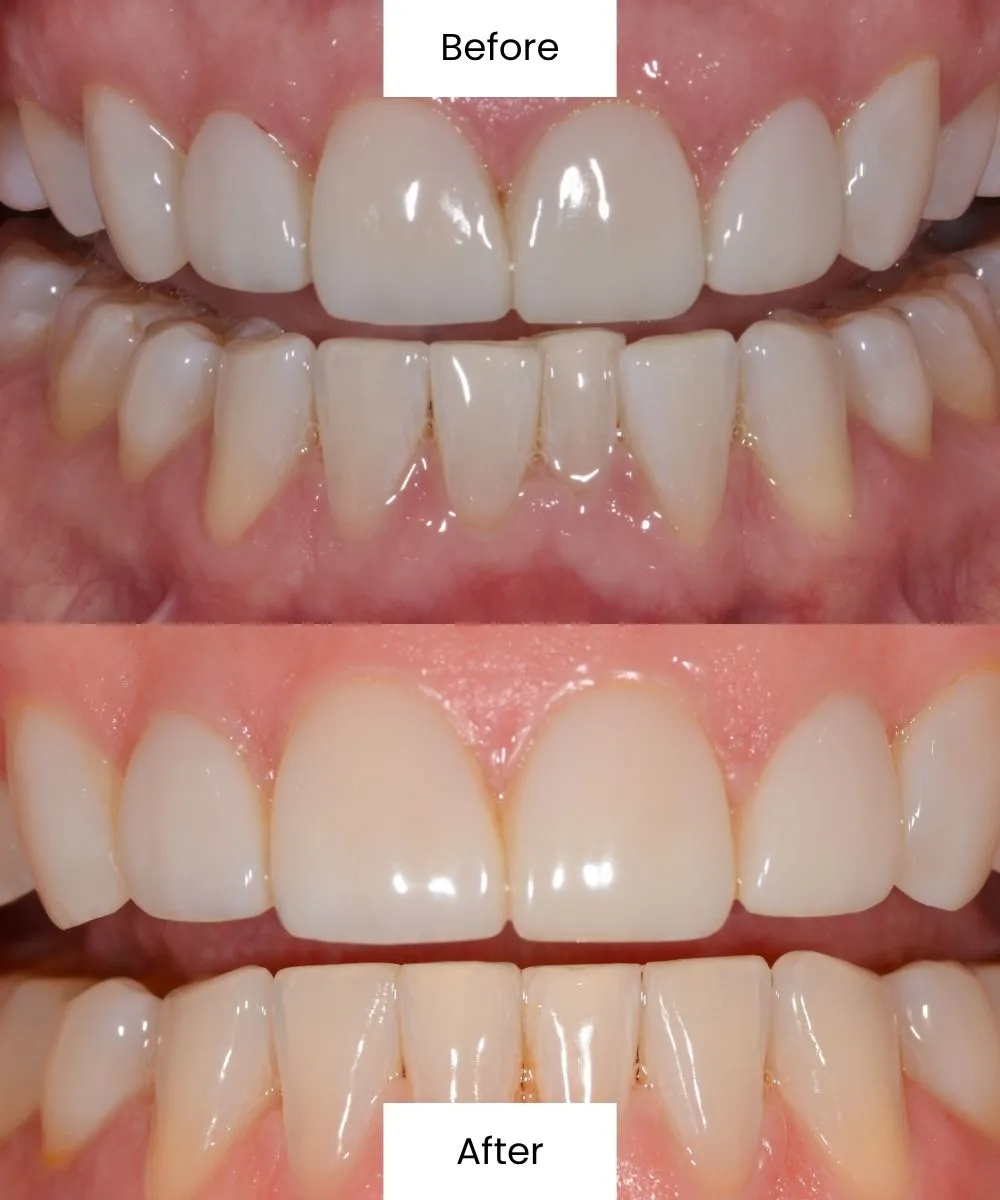 Before and after cosmetic dental treatment showing improved smile symmetry and appearance
