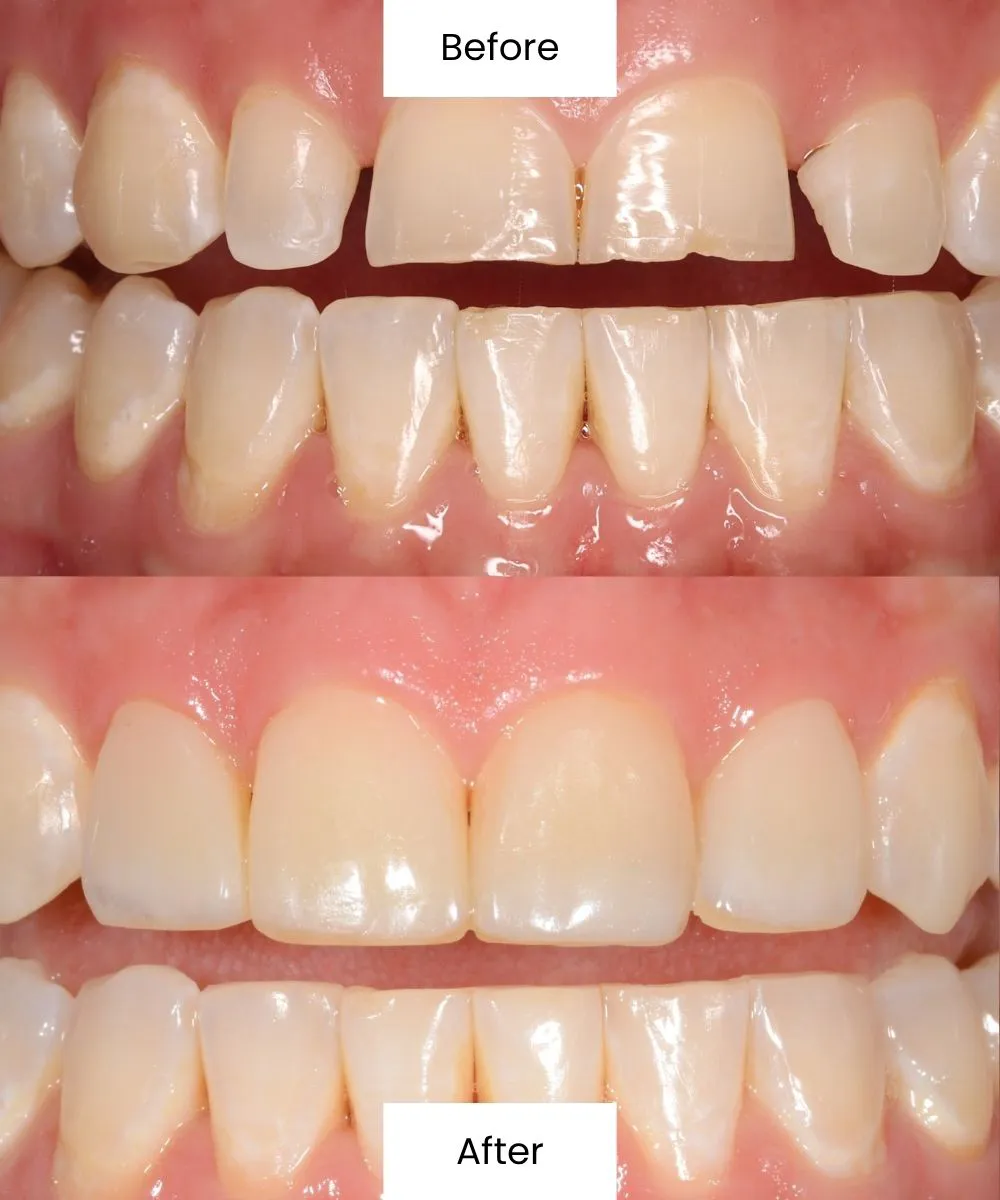 Before and after treatment improving the appearance of enamel discoloration and surface irregularities
