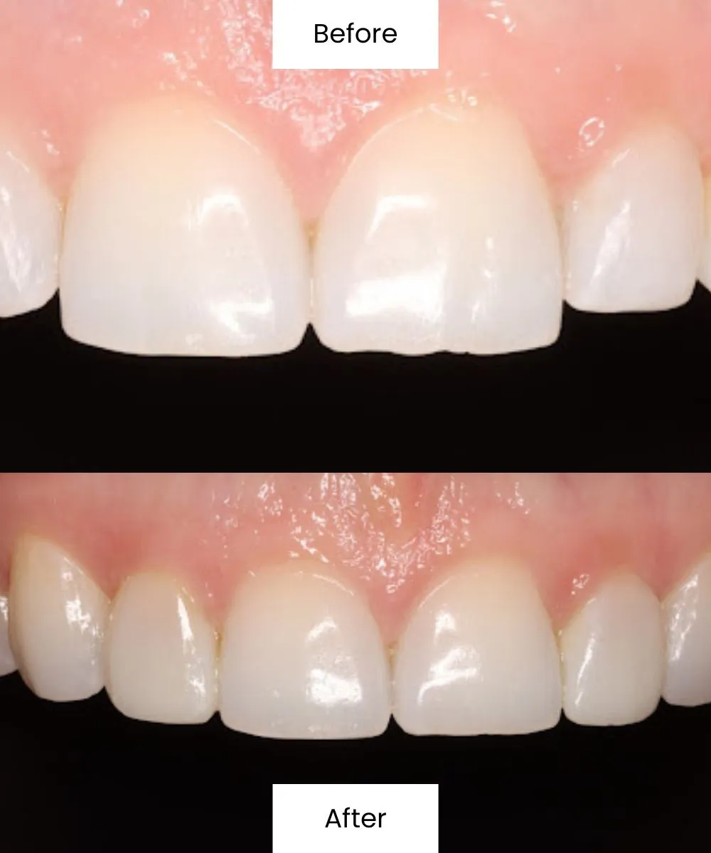 Before and after treatment improving front tooth appearance and smile balance