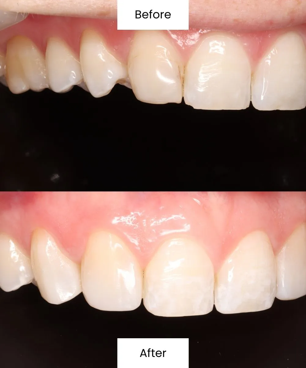 Before and after treatment correcting damage and improving the appearance of front teeth