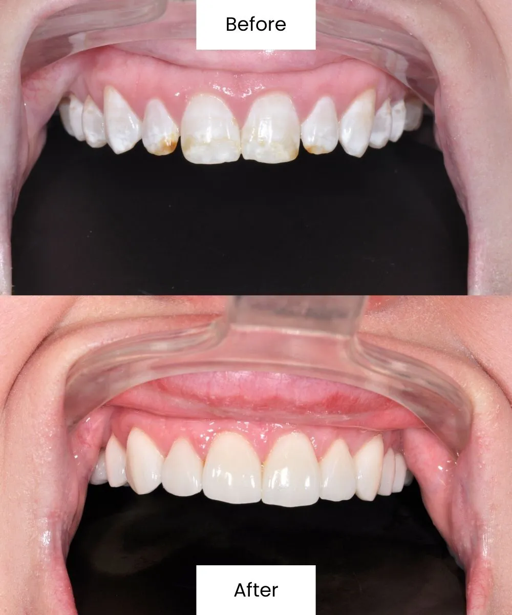 Before and after smile transformation with improved tooth position and overall balance
