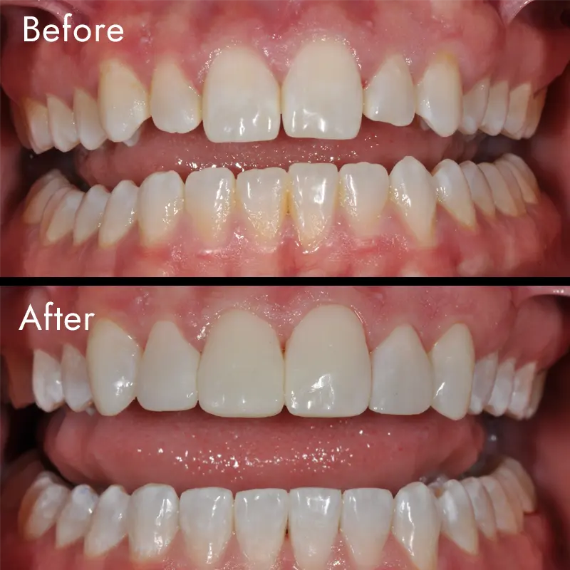 Before & After Teeth Whitening Pragma Patient